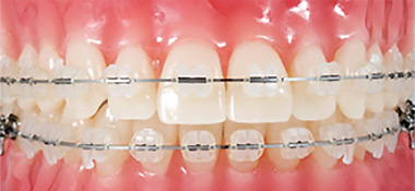 器具が目立たない表側矯正