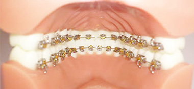 器具が見えない裏側矯正