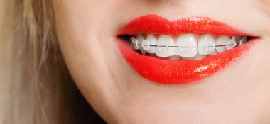 1本だけ、前歯だけ部分矯正